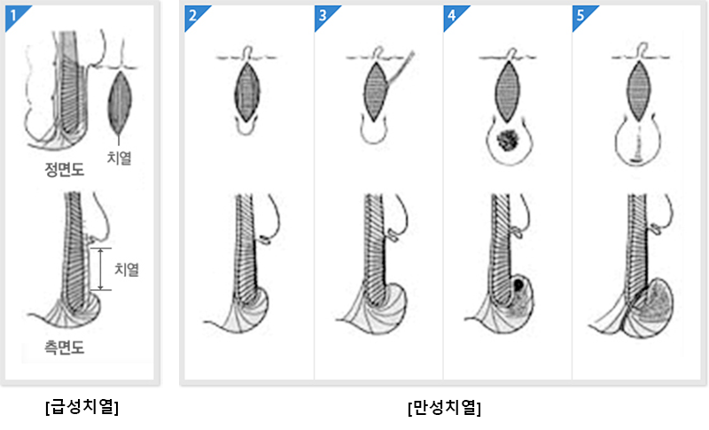 급성치열