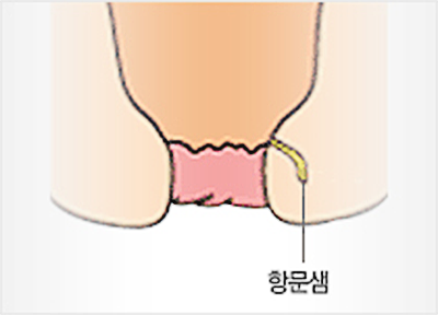 항문샘에 염증이 생깁니다.