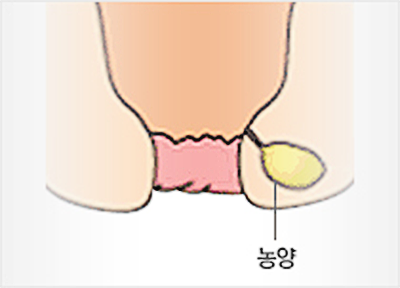 항문주위 농양이 됩니다.