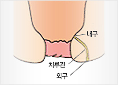 만성화되어 치루가 됩니다.