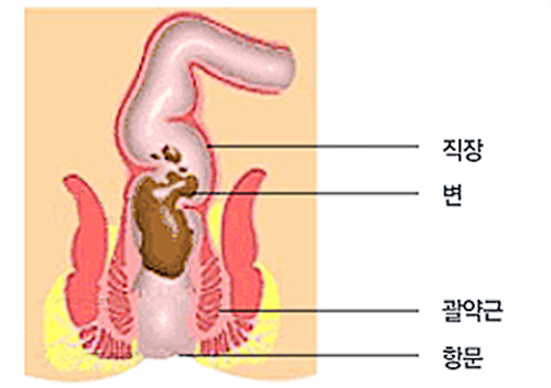 만성변비