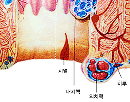 치질의 종류