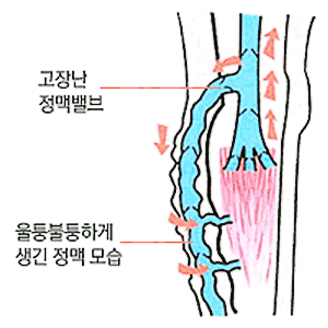 “정맥류가