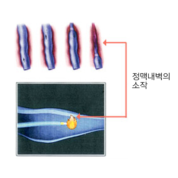  하지정맥류의 레이저치료